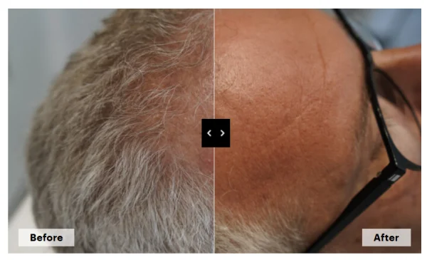 Mesoestetic Hair care solution